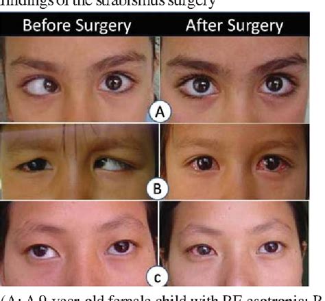 Pdf Outcome Of Horizontal Strabismus Surgery And Parents