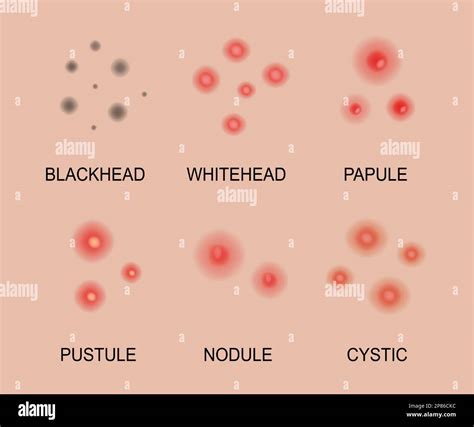 Different Types Of Acne Acne Skin Types Blackheads Whiteheads