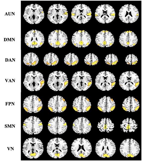 Frontiers Evidence Of Neuroplasticity With Braincomputer Interface