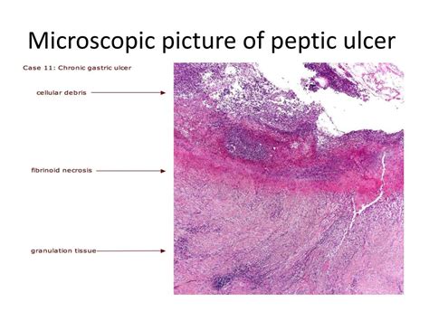 Peptic Ulcer Histology