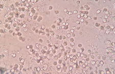 Urine Test Pus Cells In Urine Normal Range