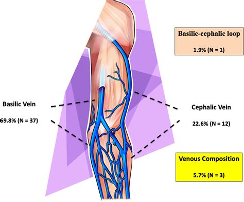 Efficacy And Safety Of Iliofemoral Bypass Using Arm Veins As An