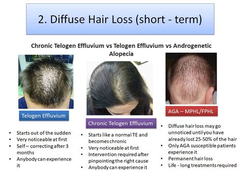 Short Term Vs Permanent Hair Loss And The Best Treatments For Both