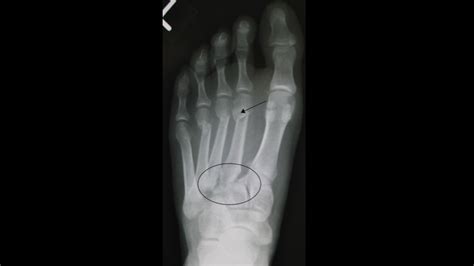 Injury Lisfranc Fracture