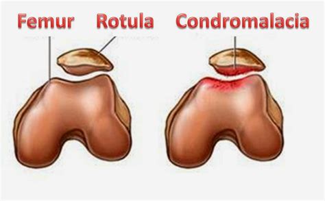 Condromalacia rotuliana Dr. Delgado | DELGADOTRAUMA