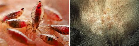 Piojos fotos en el cabello de la cabeza cómo se ven al microscopio