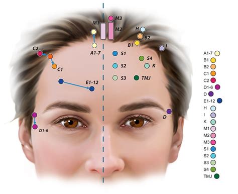 Acupuncture For Sinus Problems Illustration By Dna Illustrations Inc