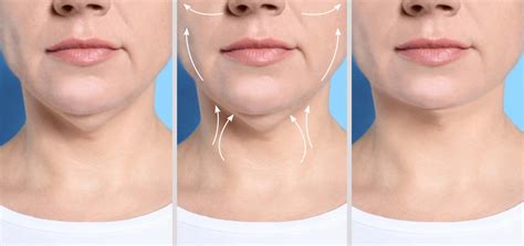 Double Chin Treatments That Actually Work Heal N Cure