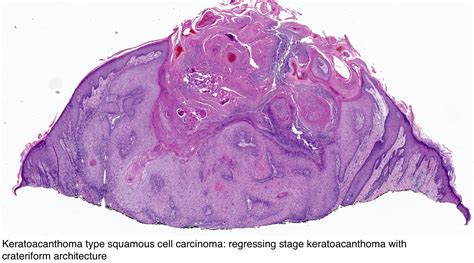 Pathology Outlines Squamous Cell Carcinoma