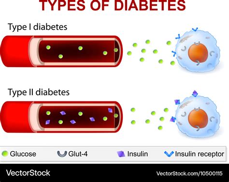 Diabetes Typ Unterschied Diabetes Typ Oder Honor Assign Co