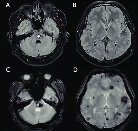 T2 Fluid Attenuated Inversion Recovery Flair Weighted Mri Sequences Download Scientific