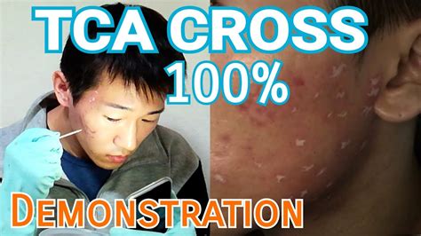 How To Use TCA CROSS 100 Demonstration Self Treatment At Home For