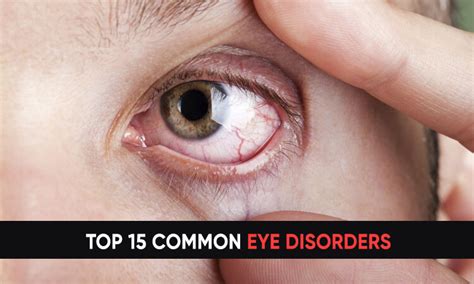 Diseases And Disorders Of The Eye Chart Poster Laminated Ponasa