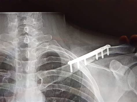 My xray after I broke my collar bone in a motorcycle accident. : r