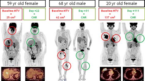 Petct Scans Of Three Different Patients Before And After Ari Cell