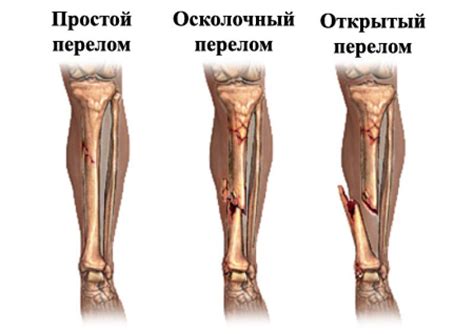 Открытый перелом - признаки, причины, симптомы, лечение и профилактика ...