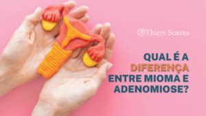 Qual A Diferen A Entre Mioma E Adenomiose Dr Thiers