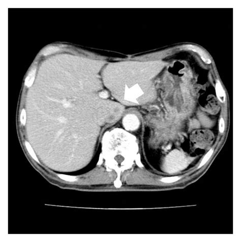 Enhanced Computed Tomography CT Of The Abdomen The Tumor Was