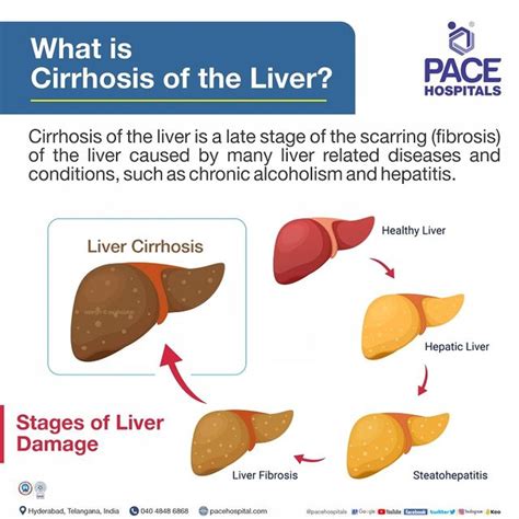 Understanding Cirrhosis Causes Symptoms And Treatment Ask The