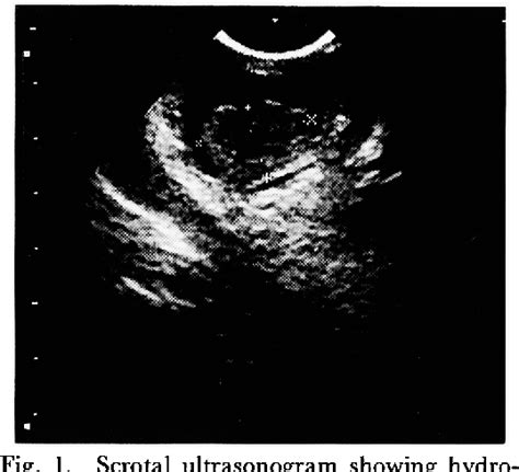 Figure 1 From Title Acute Scrotal Swelling In Henoch Schonlein Purpura A Case Report Semantic