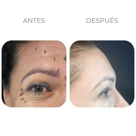 Aplicación de Botox en Bogotá Dr Ricardo Becerra