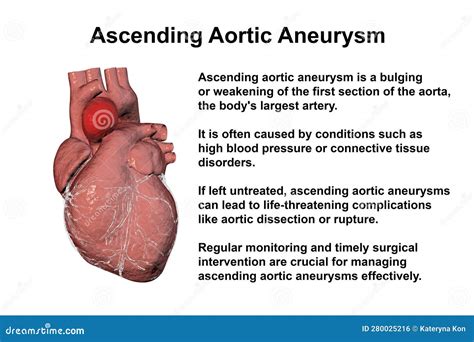 A Human Heart With An Ascending Aortic Aneurysm D Illustration Stock