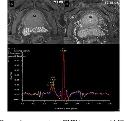 Figure From Role Of Multiparametric Magnetic Resonance Imaging In The