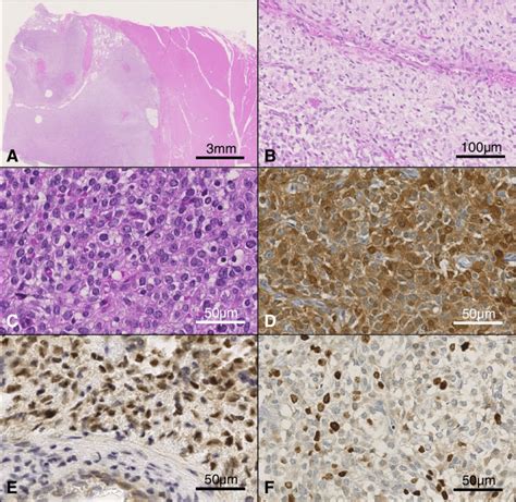 Microscopic Presentation Of The Resected Tumor Staining With