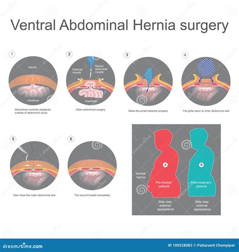 Ventral Hernia Is A Bulge Of Tissues Through An Opening Of Weakness