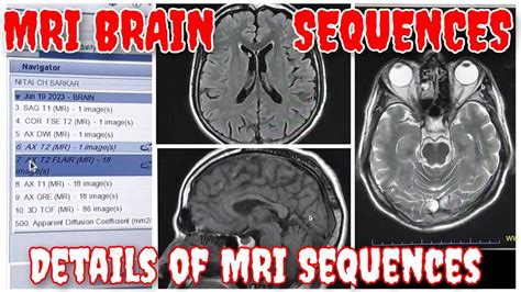 MRI Brain Sequences In Details Basic Of MRI Routine Sequences Of