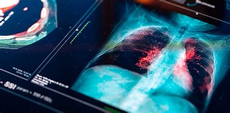 Rheumatoid Lung Disease: Causes, Symptoms, and Treatment Plans