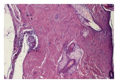 Histological Assessment Results A Study Group Scars Were Composed Of