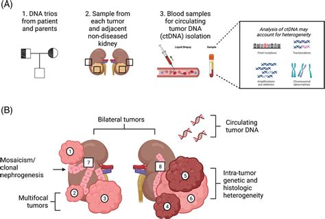 The Pathophysiology Of Bilateral And Multifocal Wilms Tumors What We