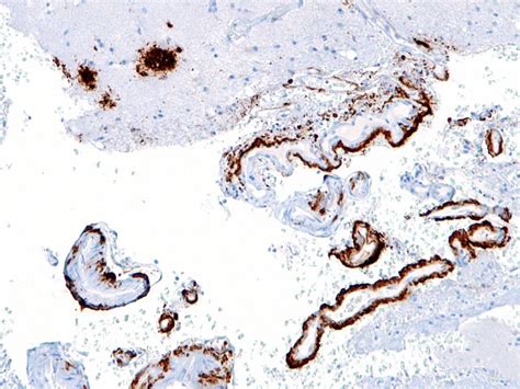 Leqembi (lecanemab-irmb) for the Treatment of Alzheimer's Disease, USA