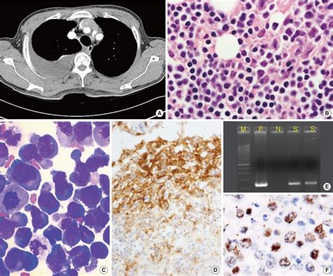 Primary Effusion Lymphoma Pel A Axial Computed Tomography Scan