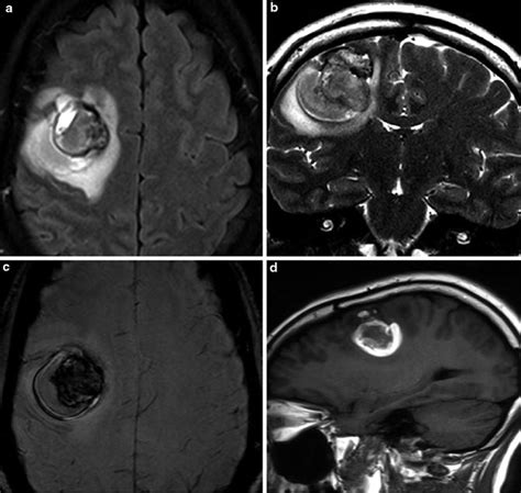 Miscellaneous Vascular Malformations Cavernous Malformations Developmental Venous Anomaly