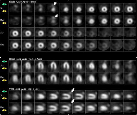 Focal Breast Uptake Of M Tc Sestamibi In A Hematoma Journal Of