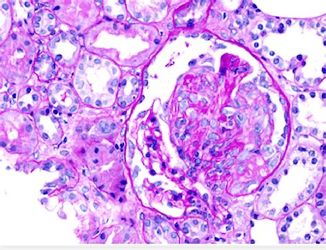 Light Microscopy Of The Renal Biopsy Showing Fibrocellular Crescent