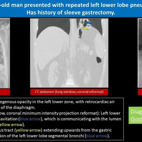 Iatrogenic Vesico Uterine Fistula References Clinical Imaging Hamad