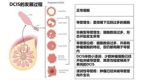 乳腺导管原位癌（dcis 中国医学影像联盟 China Medical Imaging Association