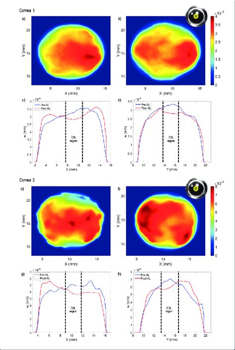 Pre Corneal Cross Linking CXL Vs Post CXL Central 3 Mm Responses Of