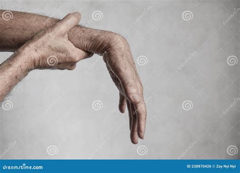 Radial Nerve Injury or Wrist Drop Stock Photo - Image of fingers, elder ...