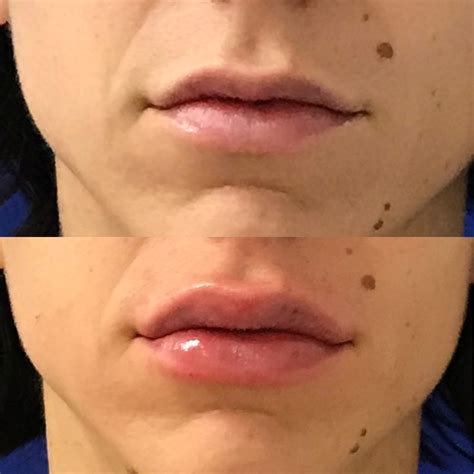 Restylane Kysse Lip Fillers In Santa Rosa And Healdsburg