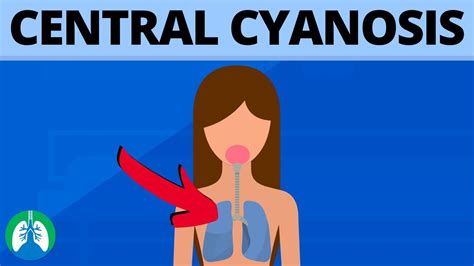 Central Cyanosis Medical Definition Quick Explainer Video YouTube