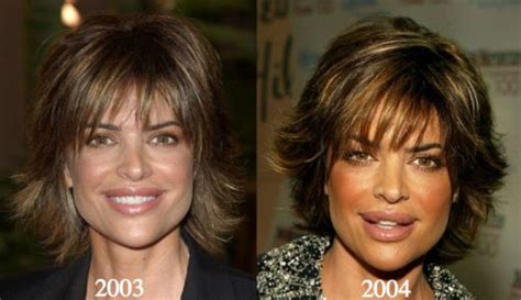 Lisa Rinna Plastic Surgery Before And After Photos Latest Plastic