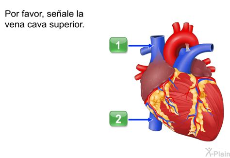 PatEdu Catéter central insertado por vía subclavia Vía SICC