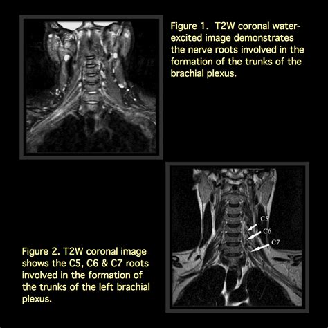 Mri Blog Brachial Plexus Mri I Ii Sexiz Pix