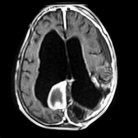 Intraventricular Meningioma Pediatric Image