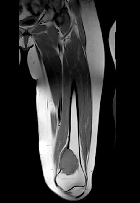Pathology Outlines Giant Cell Tumor Of Bone Nos