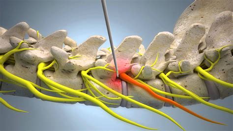 What Is A Spine Block At Archer Nettlefold Blog